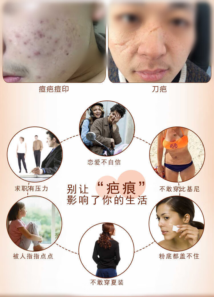 蜂胶祛刀伤疤痕膏淡化脸上黑色素沉淀痘坑印去儿童摔伤擦伤疤凹凸疤