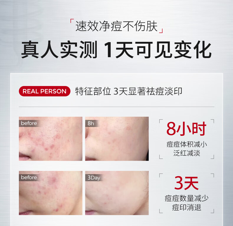 ning新加坡进口祛痘印修复淡化痘印痘坑收缩毛孔修复芦荟凝胶护肤品 【养成无痘肌】祛痘凝露50g*2支
