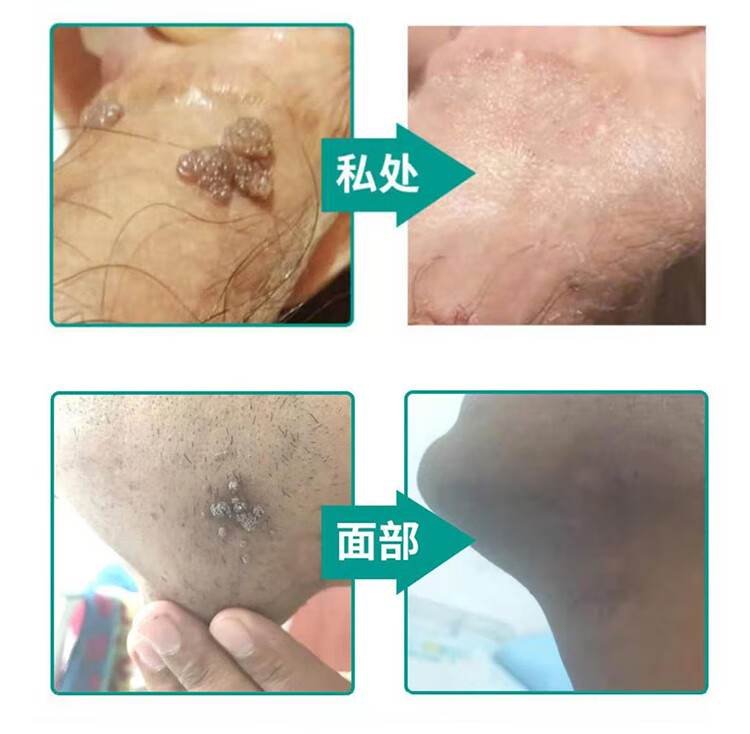 联邦优克尖锐湿疣外用肛门阴部检测保养尖锐湿疣平疣男性女性hpv