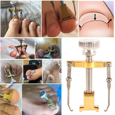 

Foot Nails Care ToolGreensen Ingrown Toe Nail Recover Correction Tool Pedicure Toenail Fixer Foot Nail Care