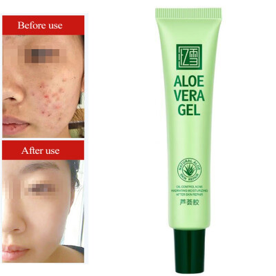 

30g Acne Treatment Blackhead Removal Anti Acne Cream Oil Control Shrink Pores Acne Scar Remove Face Care Whitening