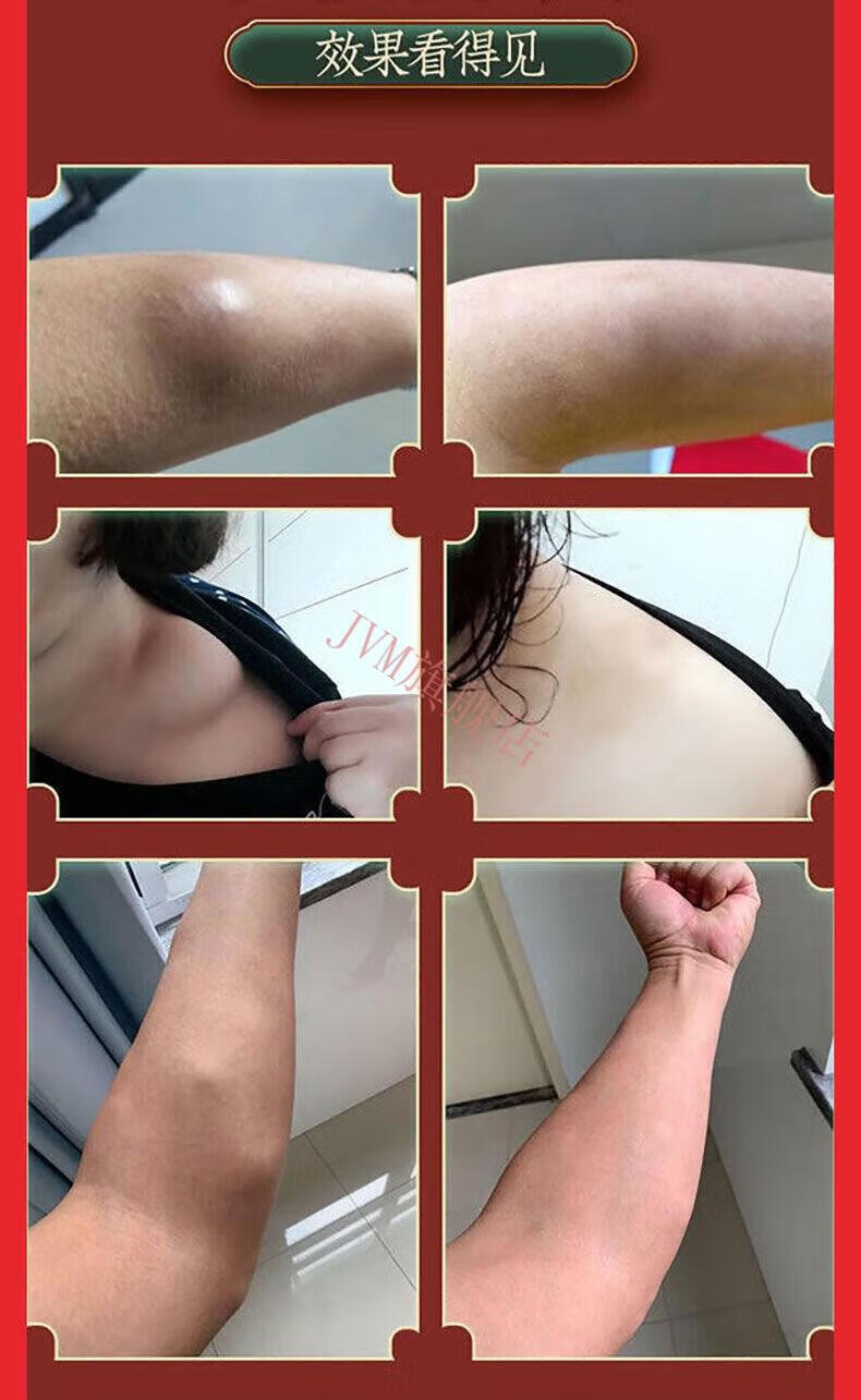 瘤膏皮下脂肪瘤硬块肿块脂肪瘤纤维粉瘤外用乳膏20g 一瓶20克【图片