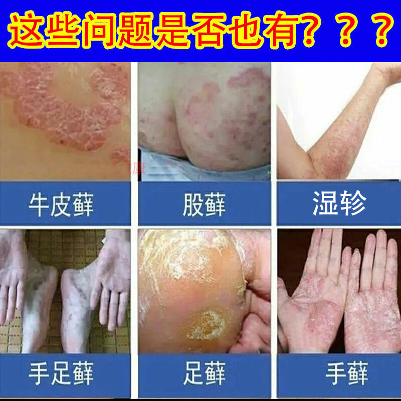 紳經性皮l炎l陰囊潮溼瘙癢股l蘚大腿內側溼l私處癢止癢王 五步祛毒膏