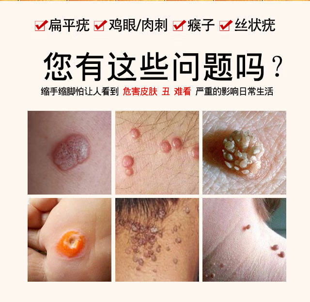 去i疣i瘊i肉粒去脖子疙瘩肉i刺扁平丝状尤鸡茧猴子神i器一抹无忧 1盒