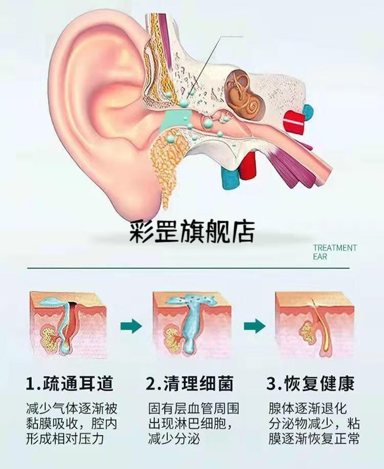 专用中耳炎化脓性耳膜穿孔流脓耳痛痒耳鸣红肿耳炎 三盒 (严重顽固装)