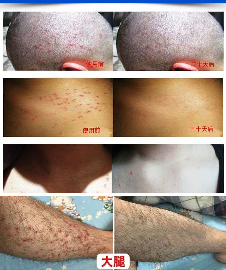 爱护佳治毛囊炎药膏头部头皮背部脸部脓疮包痤疮痘痘止痒膏皮肤瘙痒