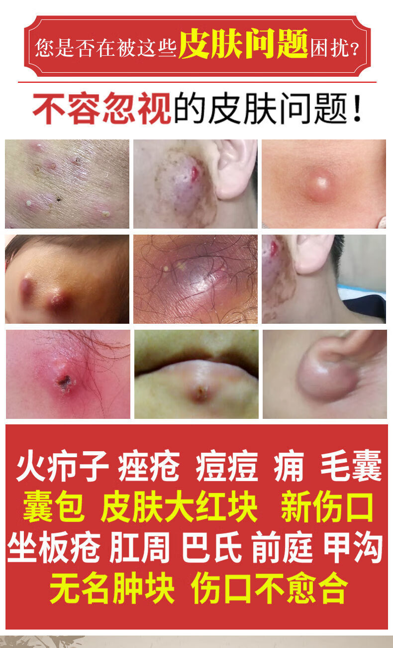 拔毒膏火疖子拔脓膏红肿脓包痘痘坐板疮黑贴单德文冷敷贴 6厘米5贴