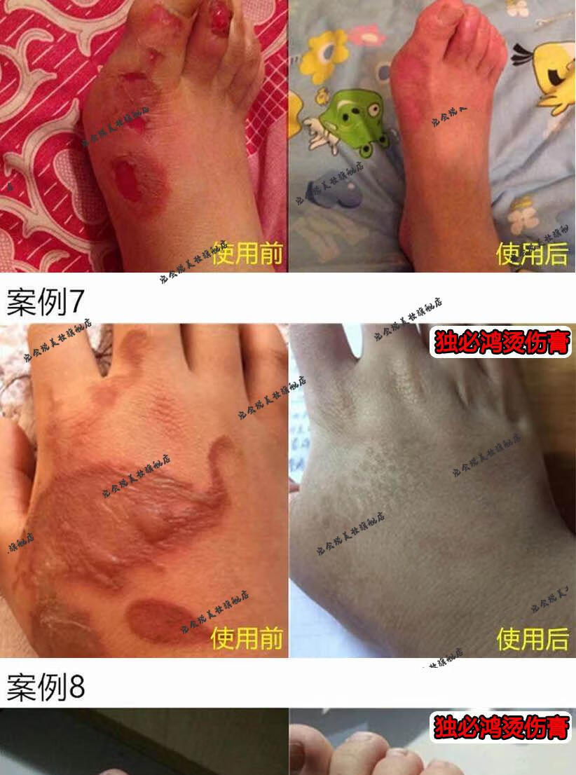 烫伤膏烧伤膏热油开水烫伤外用电焊烧伤创伤烫伤膏成人儿童修复膏轻者