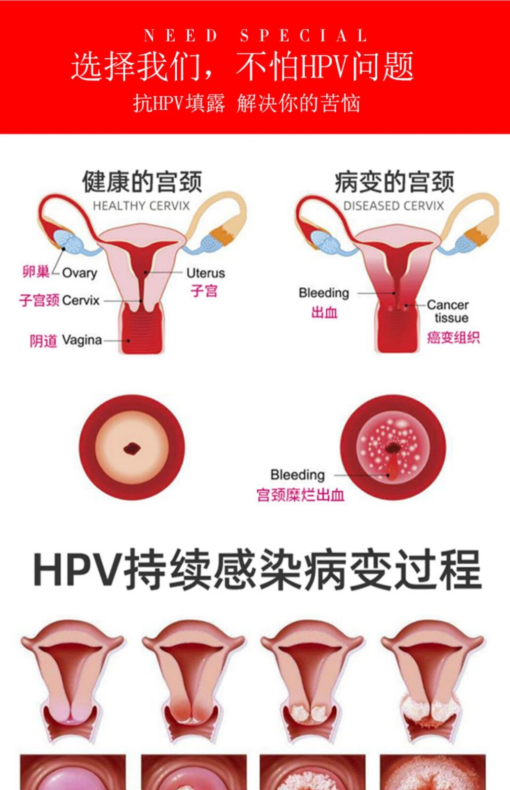 顺丰速递佩蔻爱宝疗葆抗hpv生物蛋白凝胶抗hpvβ乳球蛋白宫颈填露5g10