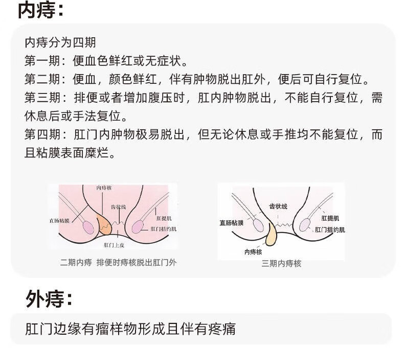 痔疮发炎水肿的图片图片