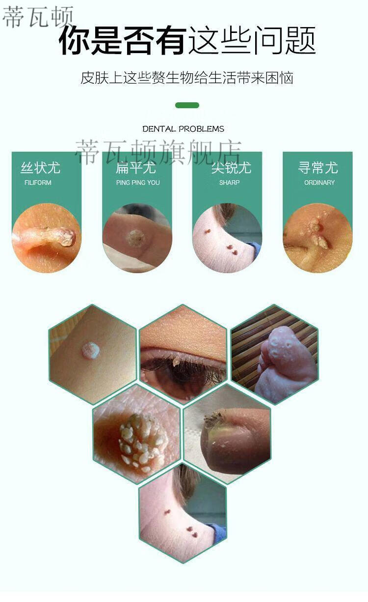 疣瘊净液去猴子疣刺祛丝状尤去除脖子小肉粒去颈部赘皮1瓶建议购买多