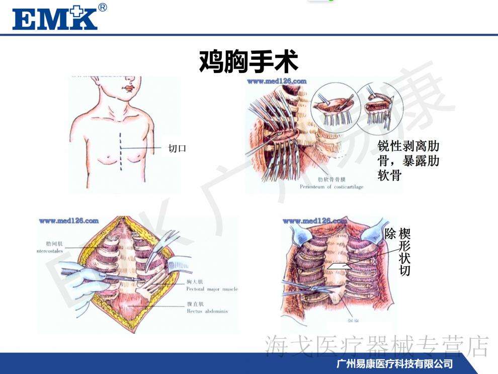 鸡胸支具 价位图片