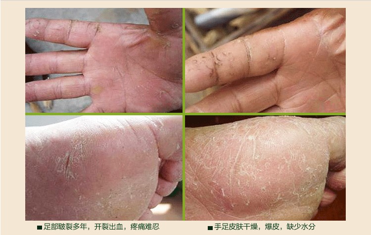 蛇由抑i菌膏奥福特奥足特知足手足裂口油手脚干鬼皲裂油膏红花由油纯