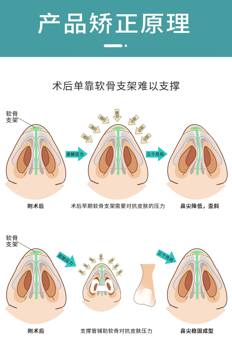 隆鼻术后支撑架 鼻综合鼻孔器隆鼻术后鼻子支撑器鼻翼支架塑型鼻夹防