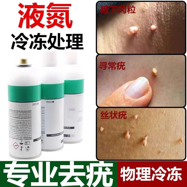 液氮去疣冷冻去疣小瓶丝状疣扁平疣点痣痦子常疣跖疣祛定制米白色去疣