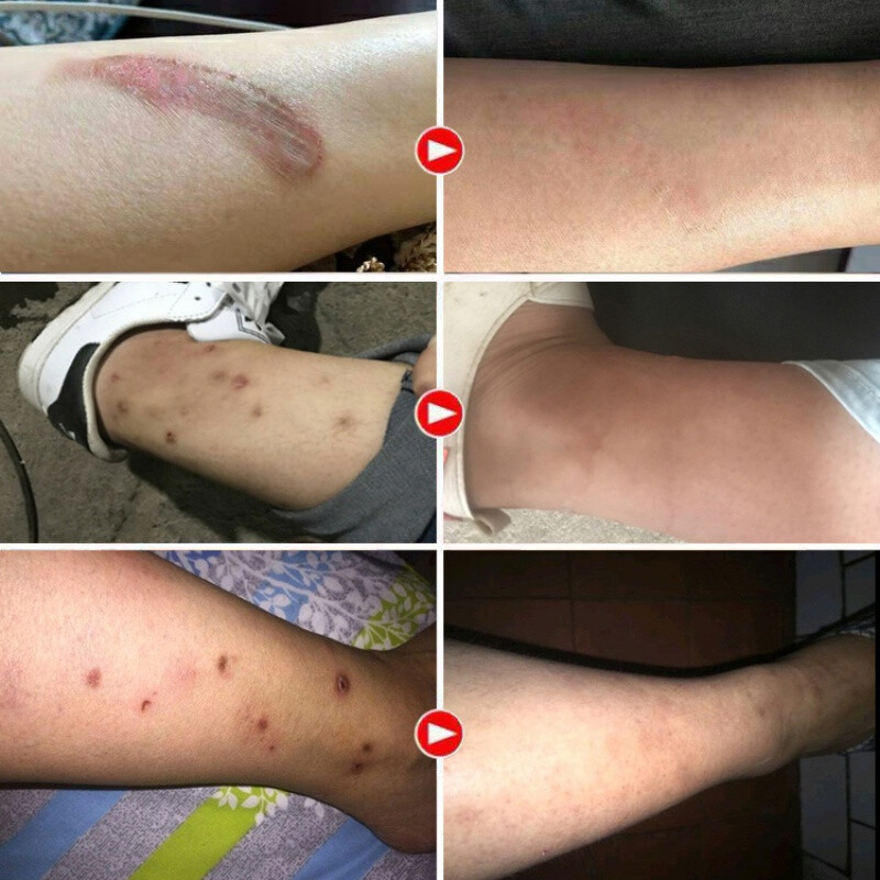 【官方旗舰】去蚊子叮咬去i疤痕印淡化疤痕去i疤痕增生凸起去除疙瘩