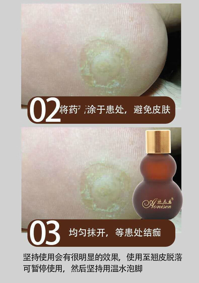 疣瘊灵澳尼森优候灵液保中宝优侯灵膏草本精华 5瓶装(三赠二)【图片