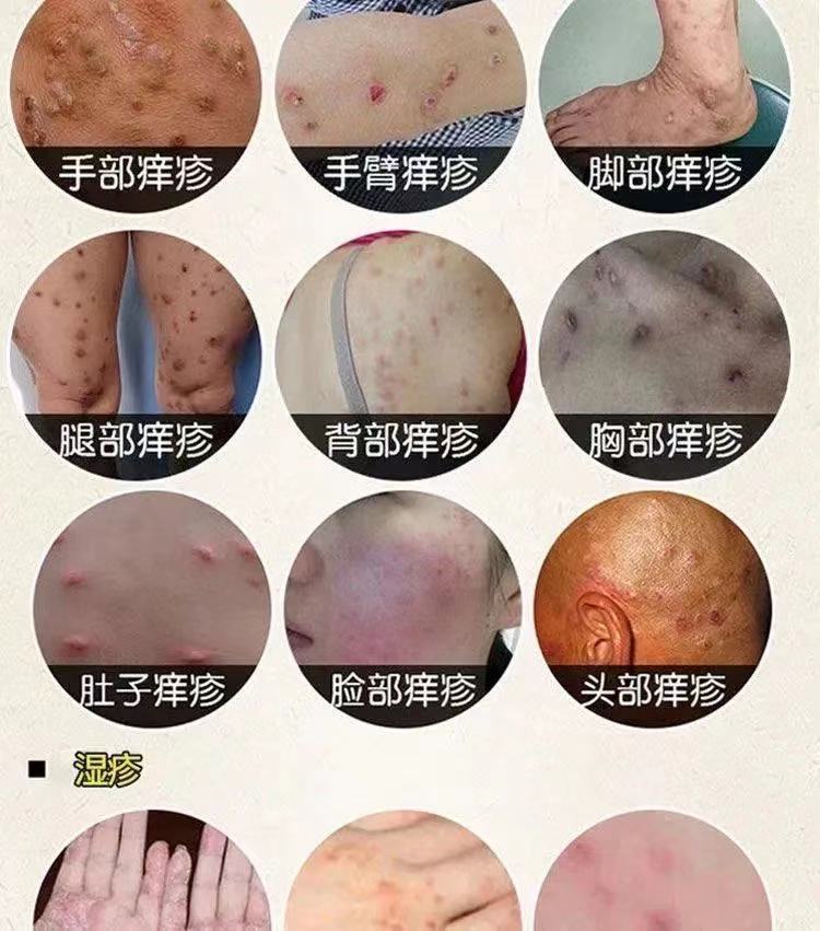 结节性痒i疹膏止痒顽固性慢性结痂性痒i疹结节性皮
