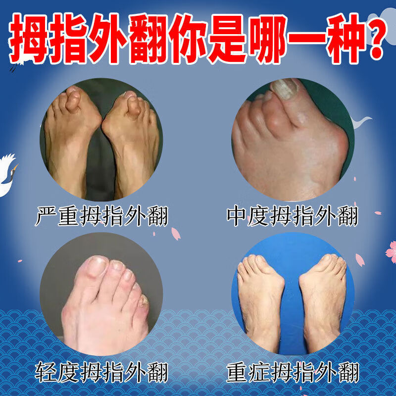 三天全愈拇指外翻矫正l器拇外翻脚趾重叠防磨大脚骨外翻专用贴32根l治