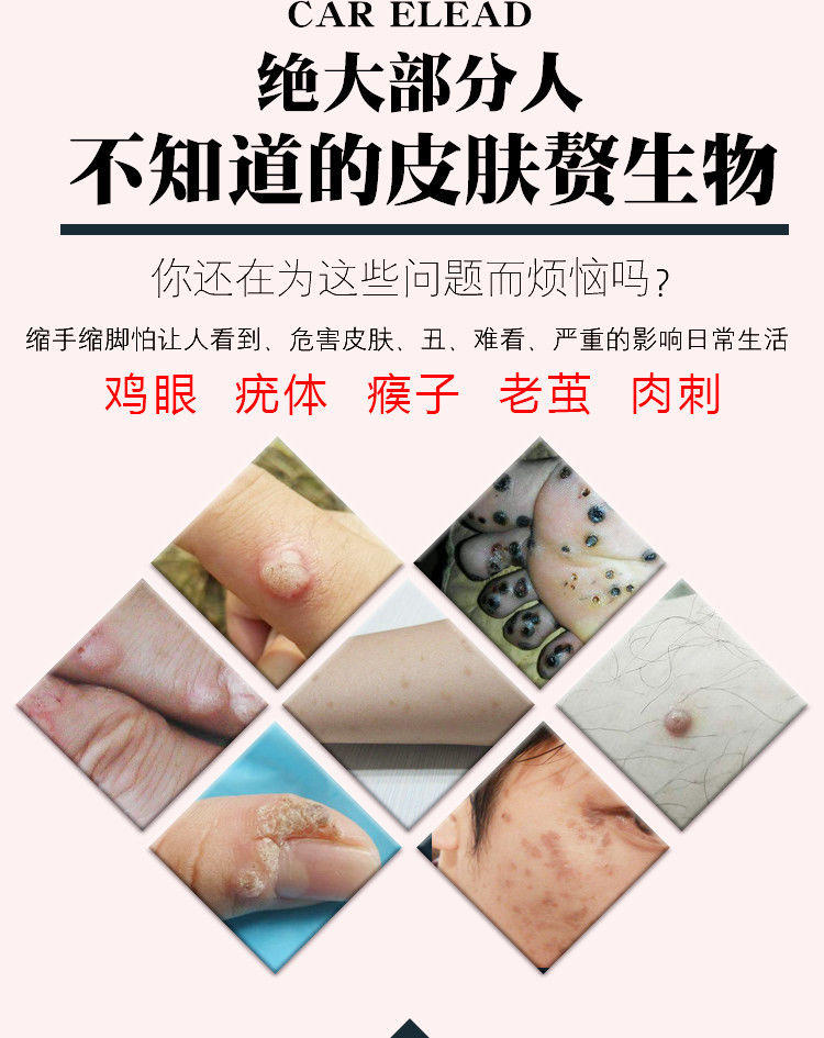 官方旗舰加丹一号草本闻夫宁手足根部老茧丝状尤肉粒疣瘊灵克尤液扁平