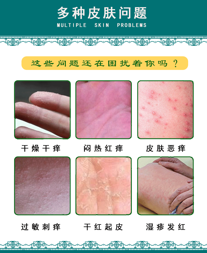 男女私处膏下身外阴肛门阴囊瘙痒大腿根内侧股沟藓屁眼痒皮肤骚痒大腿