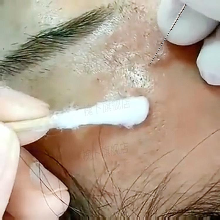 一次性挑痘针排痘针粉刺针美容院专用清痘针祛痘痘去闭口超细超尖挑