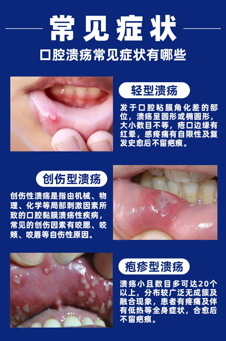 潰瘍速寧散口腔潰瘍一噴靈噴劑修復嘴巴潰爛口瘡上火舌頭起泡牙齦腫脹