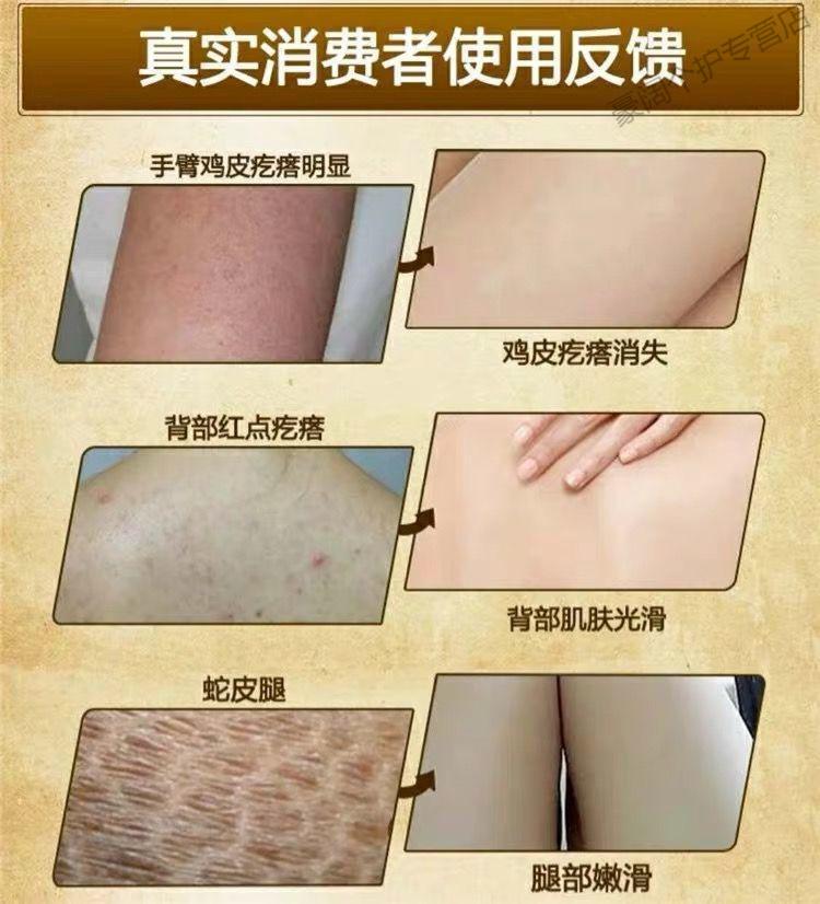 腿干燥起皮鱼鳞皮肤霜【快三天】皮肤干燥起皮去鸡皮去蛇皮修复 1盒