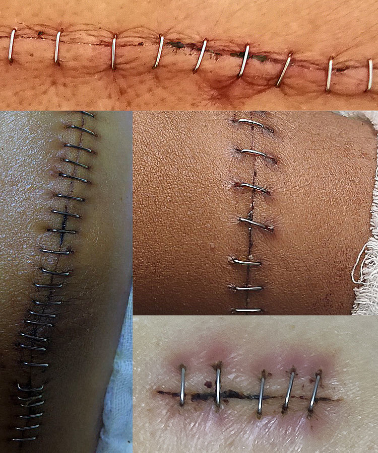 【京健康】开颅等缝合针外科手术后伤口拆钉器专用皮肤取钉器起钉器