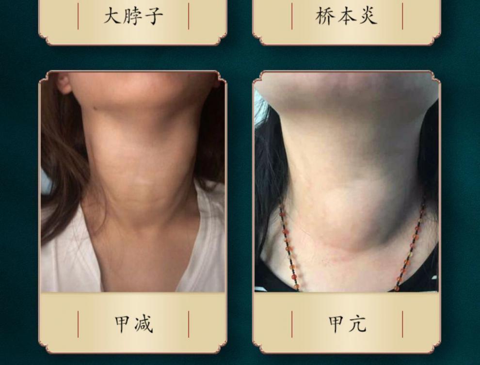 【京健康】【李时珍】甲状腺结节散结贴甲状腺贴医用冷敷贴甲状腺肿大