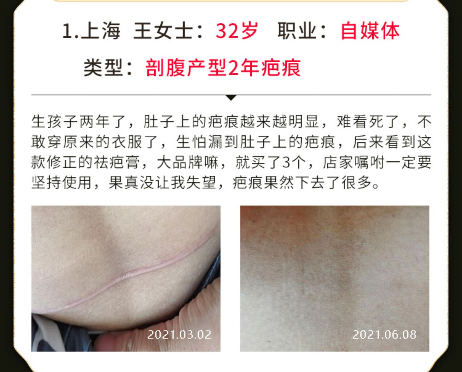 剖腹产破刨腹产抛妇产疤痕贴增生凸起软化硅酮凝胶疤痕膏非修复 1盒装