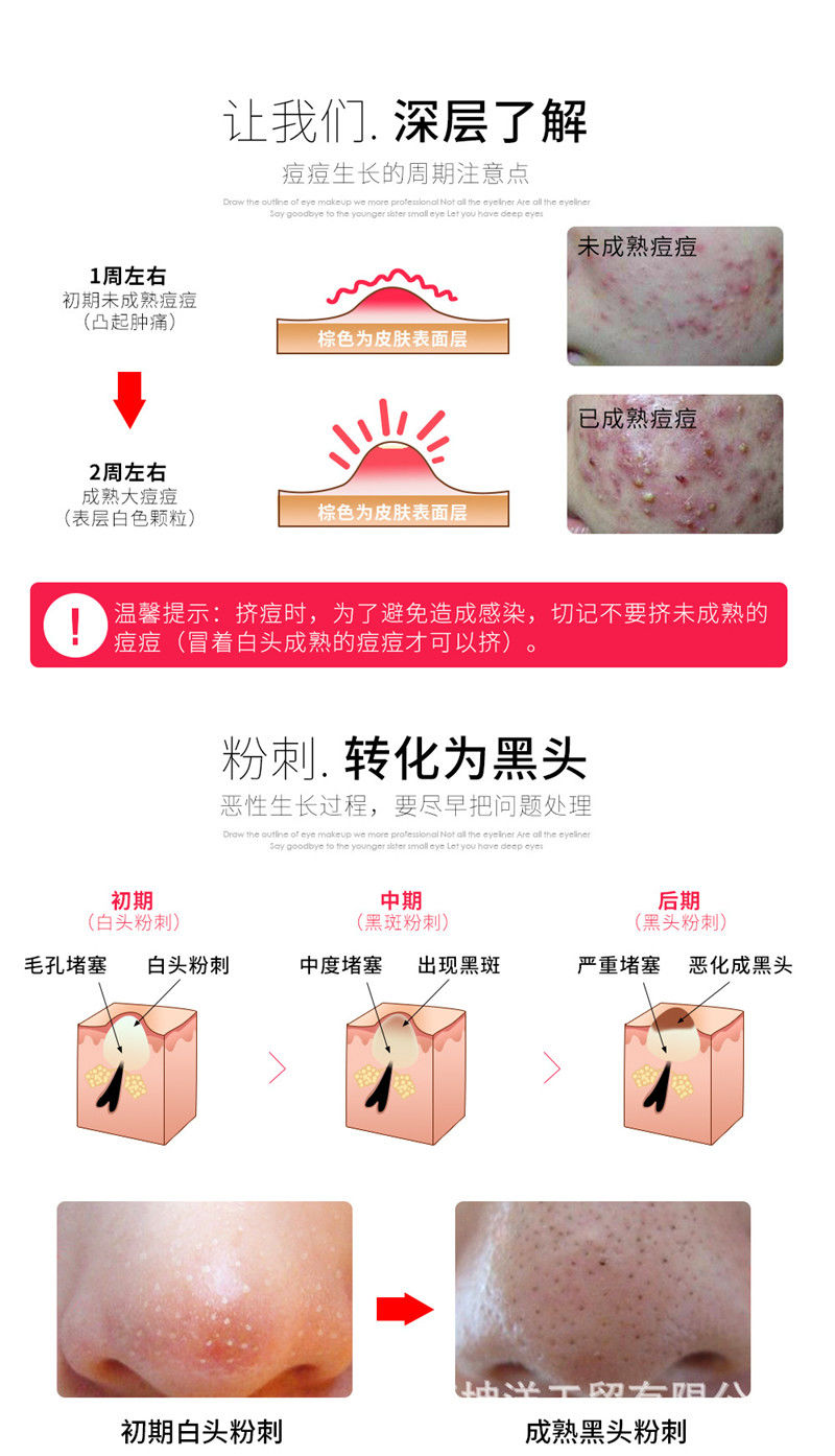 美道 粉刺针去黑头针 挑痘针 暗疮针祛痘美容针 挤痘痘镊子细胞夹套装 银色粉刺针2支装