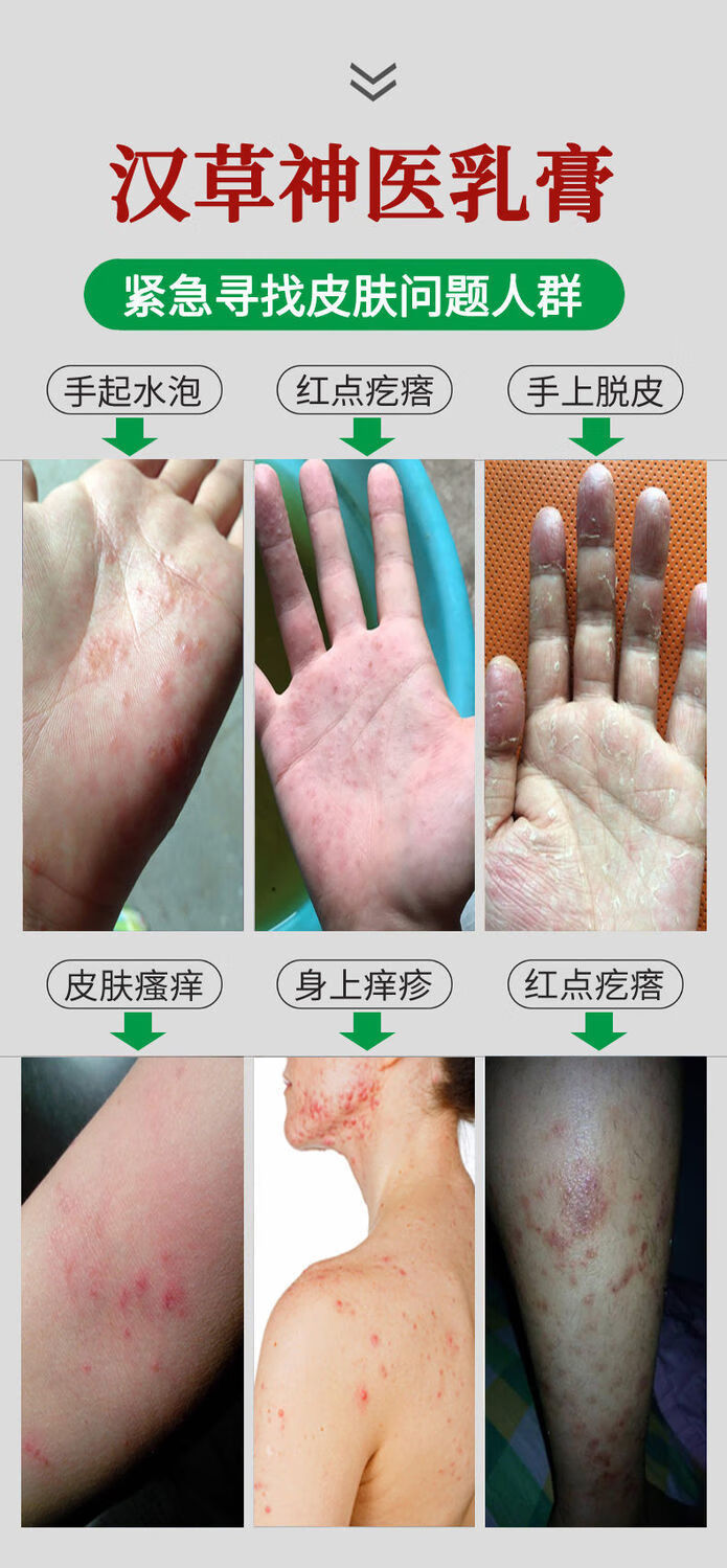 官方汉草神医止痒膏身上皮肤瘙痒手上起水泡脱皮红疙瘩神医汉草轻度