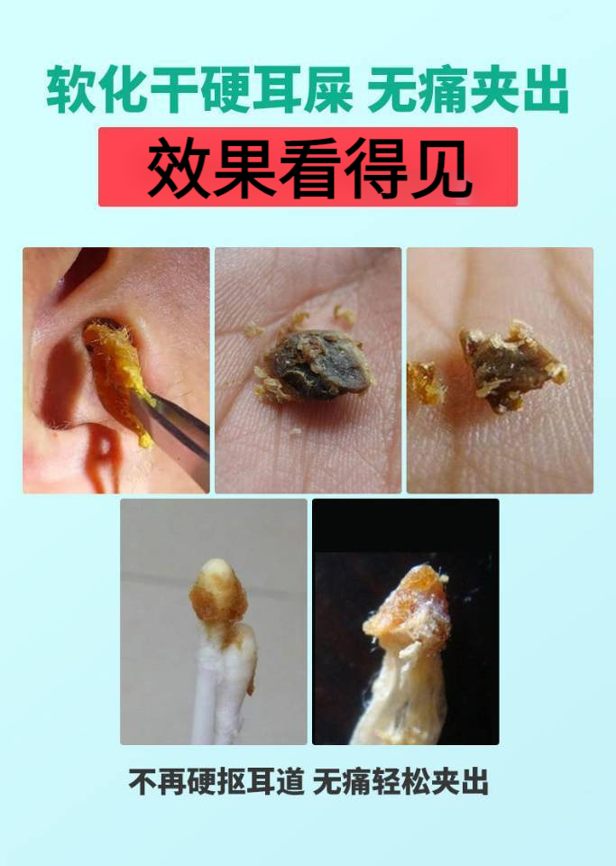 液人用耳道真菌霉菌感染耳朵痒盯眝水耳朵清洁洗耳液中耳炎耳屎软化剂