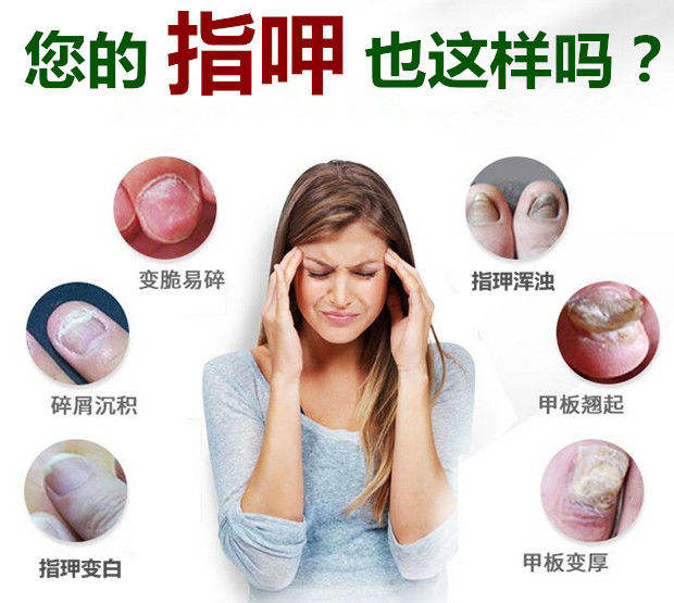 冰醋酸30% 灰指甲甲沟泡脚止痒 冰醋酸浓缩溶液醋精30%度澳福来 2斤装