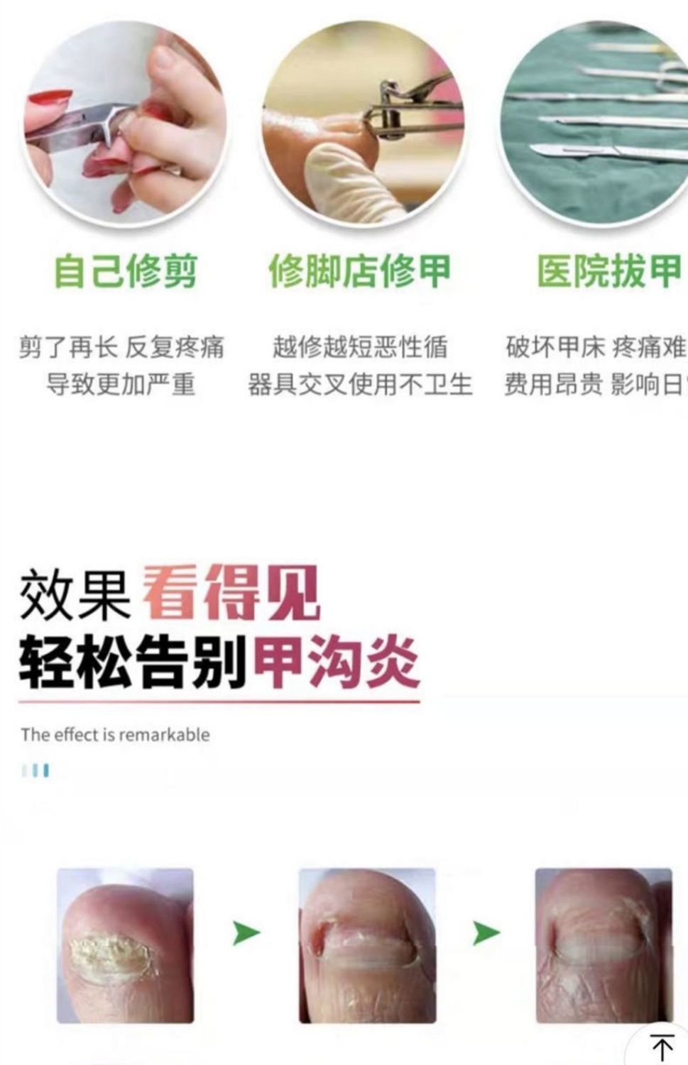 恩宝佳必力欣甲立舒滋芙宝甲沟肉芽甲利舒甲力舒保证 甲立舒*1盒