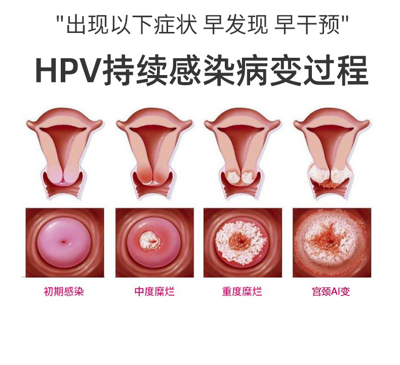 抗hpv干扰素卡波姆妇科凝胶转阴高危16型炎药 适用于hpv病毒二个疗程