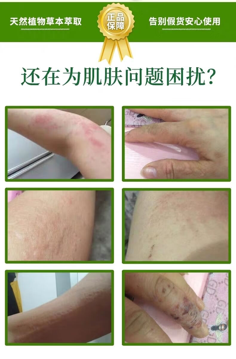 艾贝森林艾贝霜荨麻ii疹湿疹止痒祛湿所有皮肤过敏修复男女私处瘙痒
