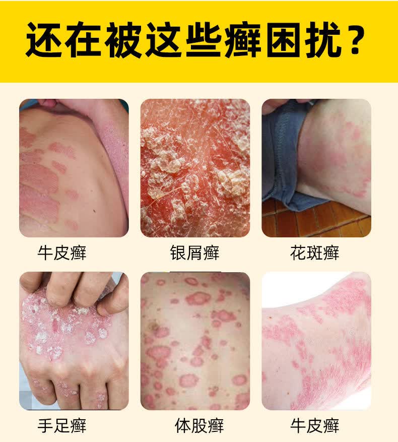 复方黄柏祛鲜癣搽剂皮肤湿病疹止痒外用癖喷剂初肤堂庆格泰1盒见效了