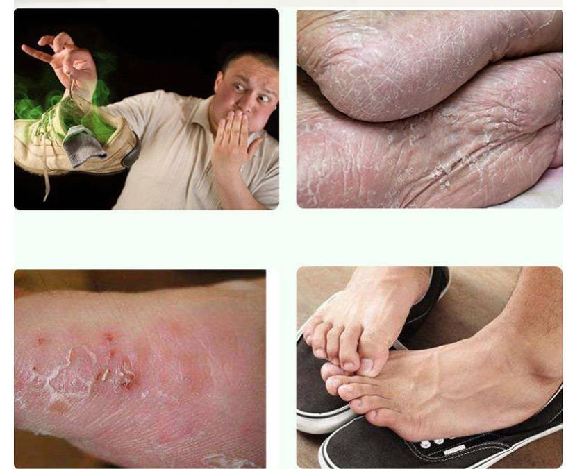 滇合一草喷脚王喷剂止痒脱皮脚臭烂1脚丫脚痒水泡型偏方去脚汗 喷脚王