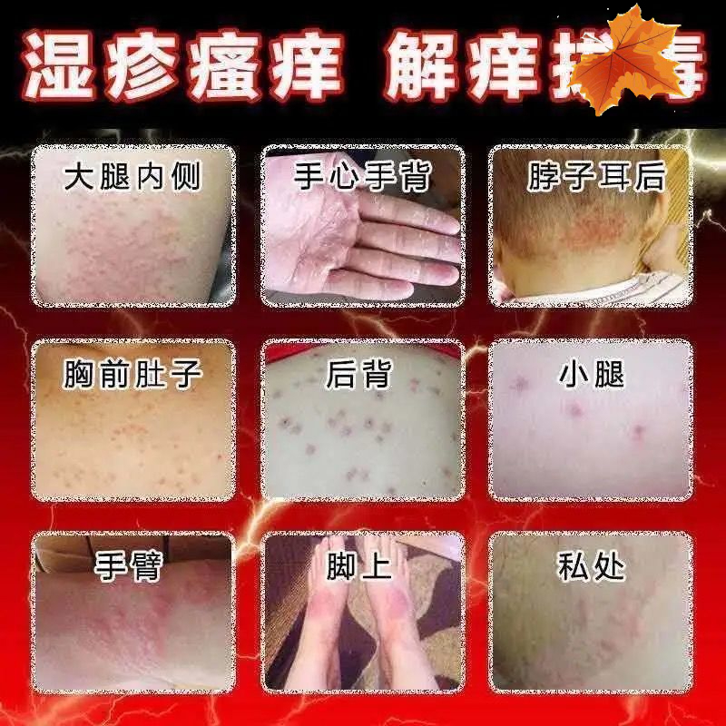 止痒膏手i癣手足i癣真菌感染汗i疱ii疹水泡手痒脱皮干裂湿ii疹止痒膏