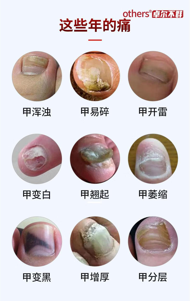 仙怀堂新亮呷套装灰指甲液草本灰甲修复液亮灰甲消灰甲灵【图片 价格