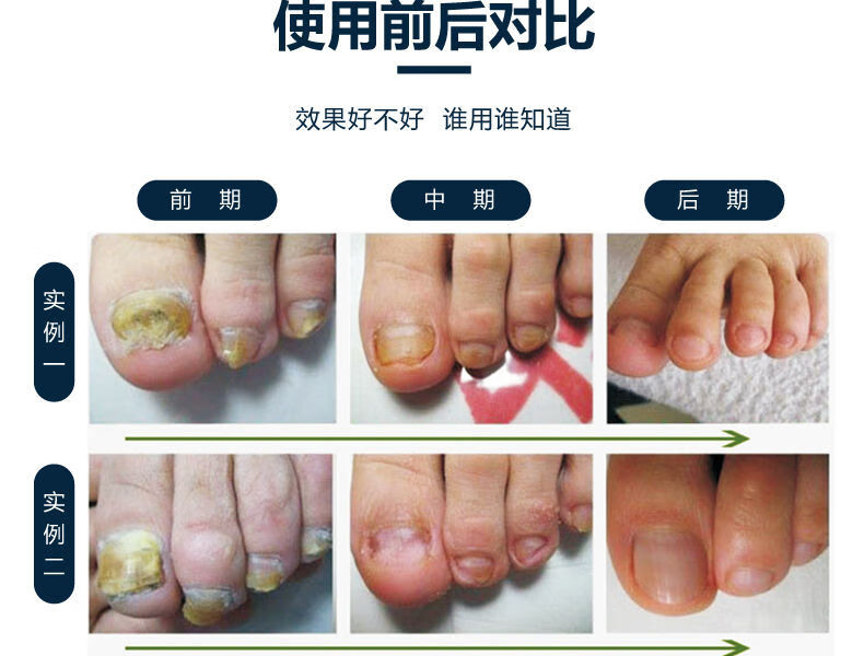 软函甲康灵软涵函甲乐康灵小白盒官方灰指趾甲冷敷凝胶修护液套一盒装