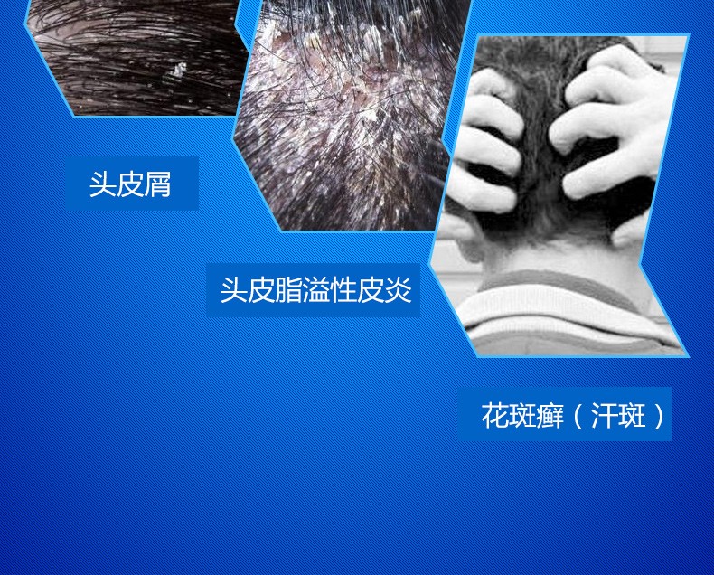 迪赛诺希尔生二硫化硒洗剂二氧化硒洗剂去屑药用去屑止痒去头屑头皮