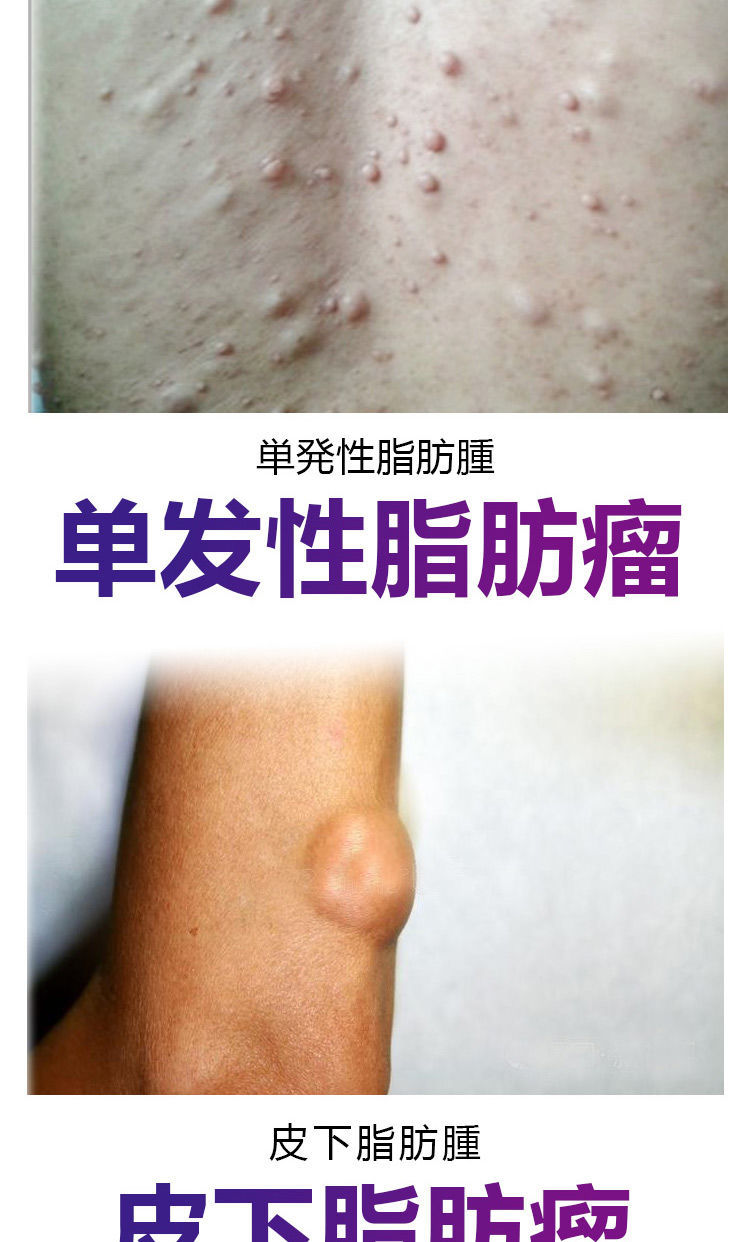 【官方旗舰】脂肪瘤祛 平涂抹36种皮下多发性脂肪瘤硬块肿块去粉瘤