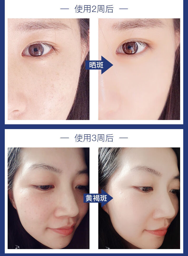 祛斑淡印仁和祛斑霜美白去斑晒雀斑黄褐斑点斑水面霜淡化雀斑晒斑老年