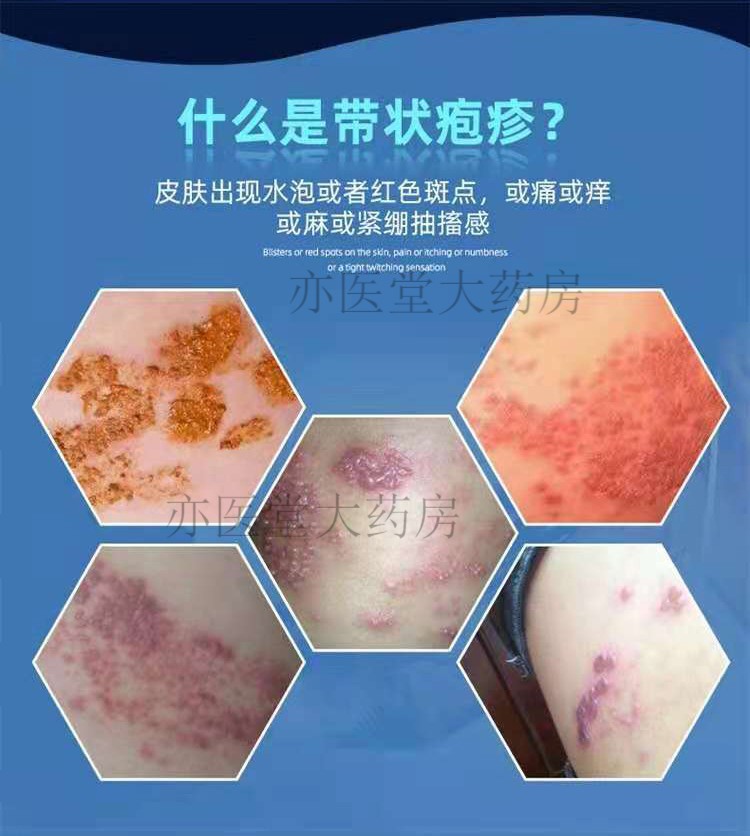 金世安带状喷剂加丹带状康十号泡遗清仁念堂康宁蛇盘清宝六号蛇盘疮蛇