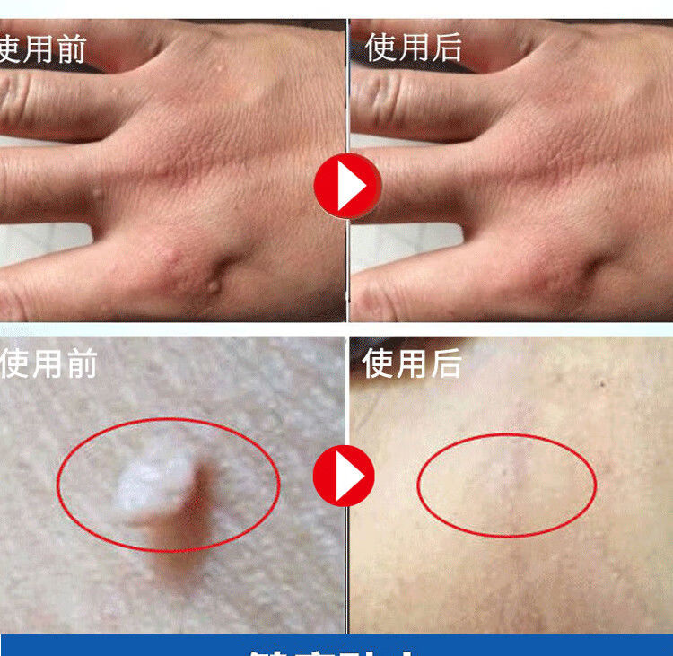 【官方旗舰】疣瘊净【无痛脱落】去除脖子腋下小肉粒祛肉瘊刺猴膏扁平
