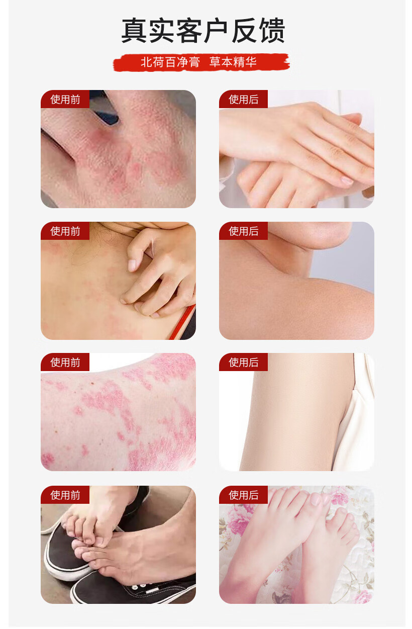 官方北荷百净膏植物草本乳膏成人儿童用涂膏皮肤痒干燥脱屑牛皮荨麻