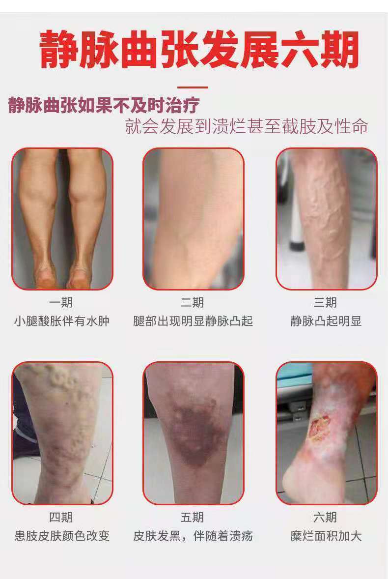 适用于静脉曲张膏蚯蚓腿部血管青筋红血丝老烂腿静脉曲张膏5盒装